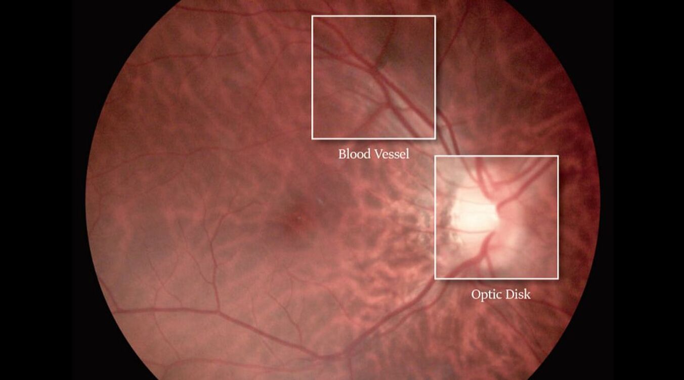 FC 161 High Resolution fundus images